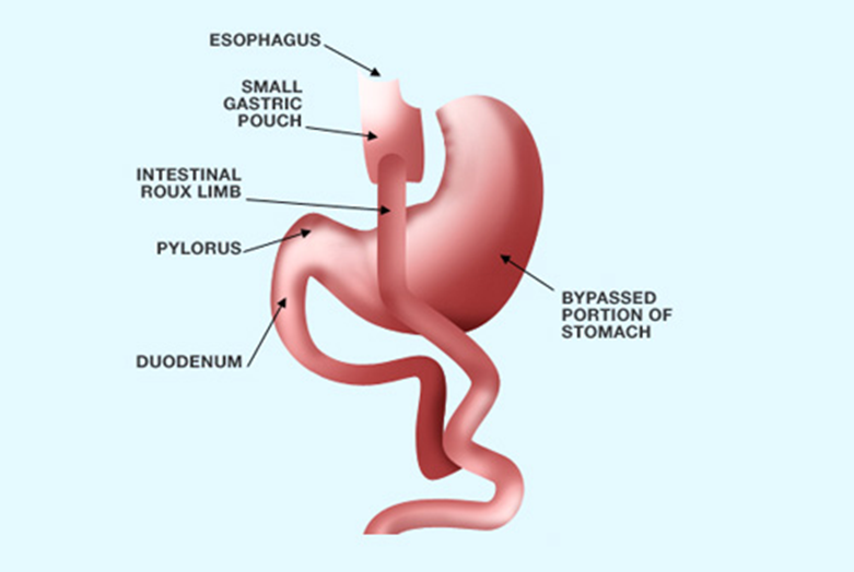 Gastric Bypass