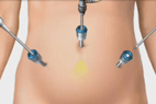 MIP (laparoscopic) hysterectomy