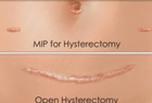 Compare scarring, open and mip hysterectomy
